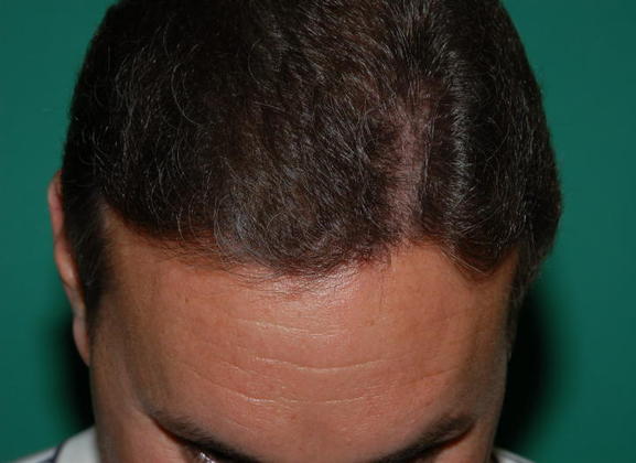 after hair retreatment