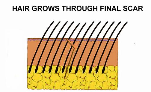 trichophytic_closure_3A.jpg Hair regrowth graphic